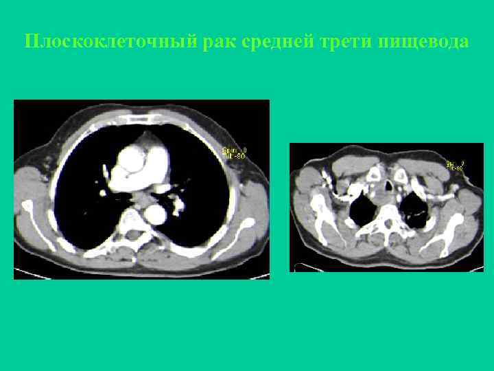 Плоскоклеточный рак средней трети пищевода 