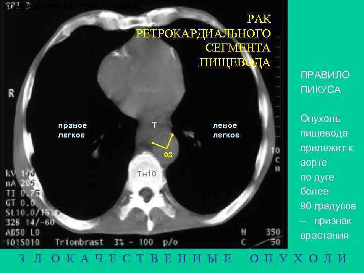 КОМПЬЮТЕРНАЯ ТОМОГРАММА РАК РЕТРОКАРДИАЛЬНОГО СЕГМЕНТА ПИЩЕВОДА ПРАВИЛО ПИКУСА сердце правое легкое Т левое легкое
