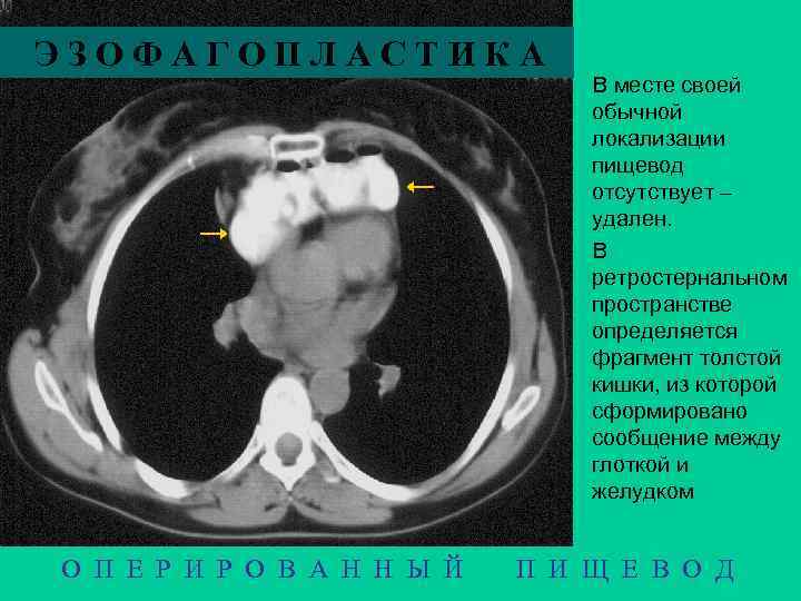 ЭЗОФАГОПЛАСТИКА О П Е Р И Р О В А Н Н Ы Й