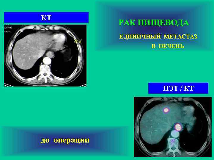 КТ РАК ПИЩЕВОДА ЕДИНИЧНЫЙ МЕТАСТАЗ В ПЕЧЕНЬ ПЭТ / КТ до операции 