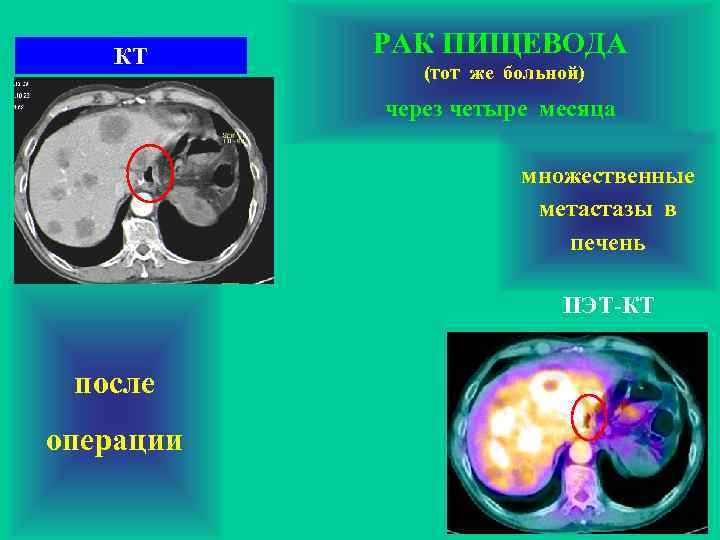 КТ РАК ПИЩЕВОДА (тот же больной) через четыре месяца множественные метастазы в печень ПЭТ-КТ