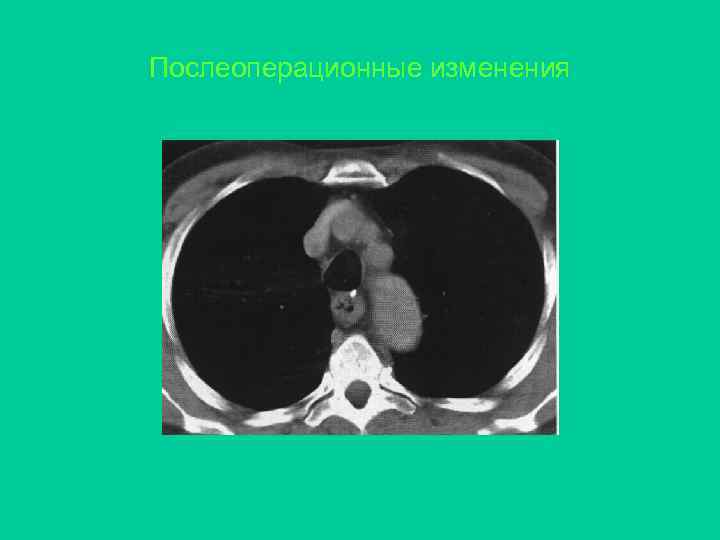 Послеоперационные изменения 