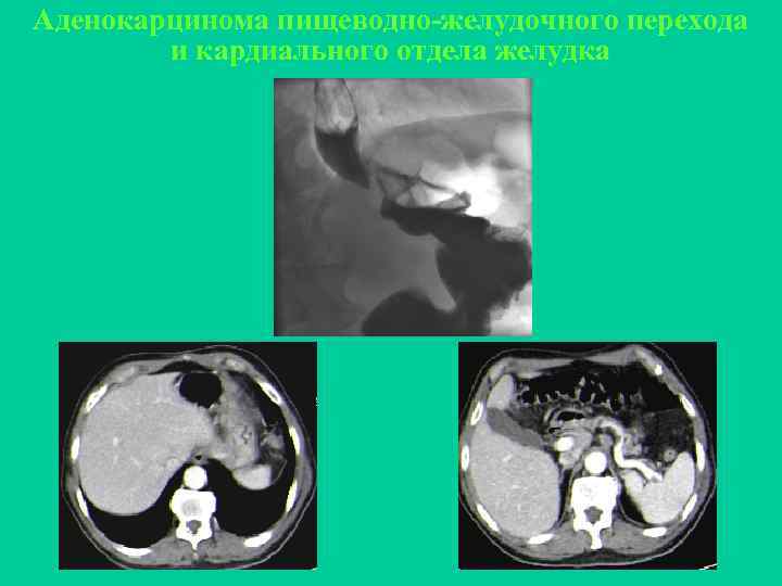 Аденокарцинома пищеводно-желудочного перехода и кардиального отдела желудка 