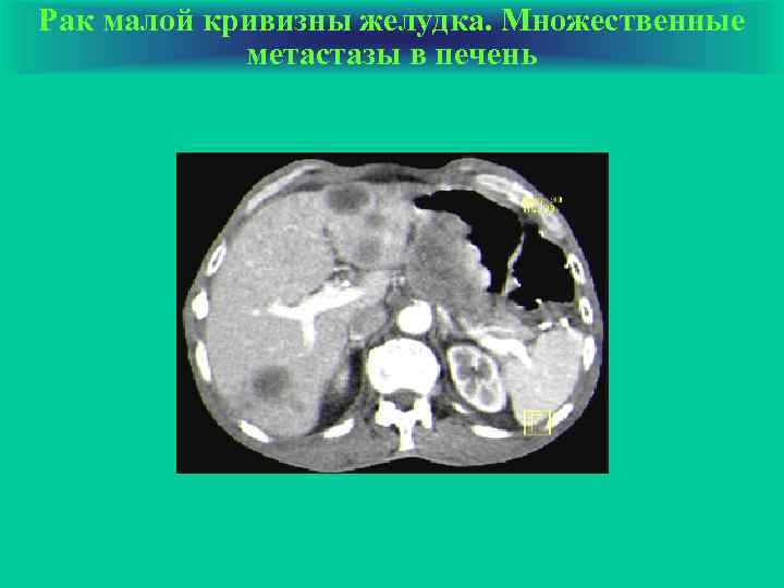 Рак малой кривизны желудка. Множественные метастазы в печень 