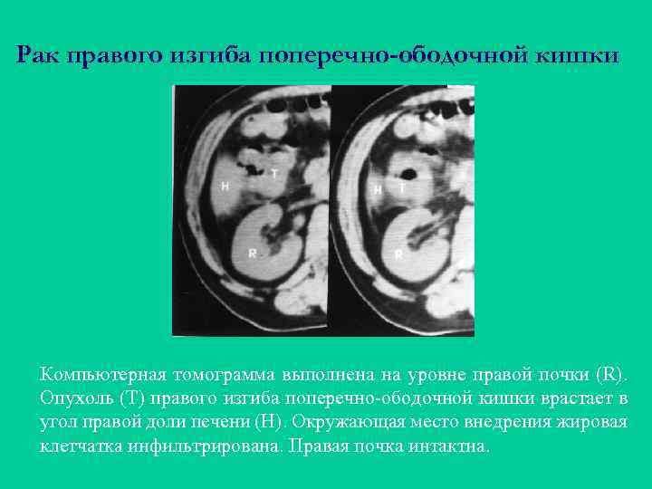 Рак правого изгиба поперечно-ободочной кишки Компьютерная томограмма выполнена на уровне правой почки (R). Опухоль