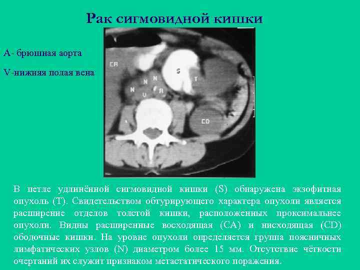 Рак сигмовидной кишки A- брюшная аорта V-нижняя полая вена В петле удлинённой сигмовидной кишки