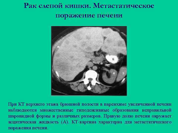 Рак слепой кишки. Метастатическое поражение печени При КТ верхнего этажа брюшной полости в паренхиме