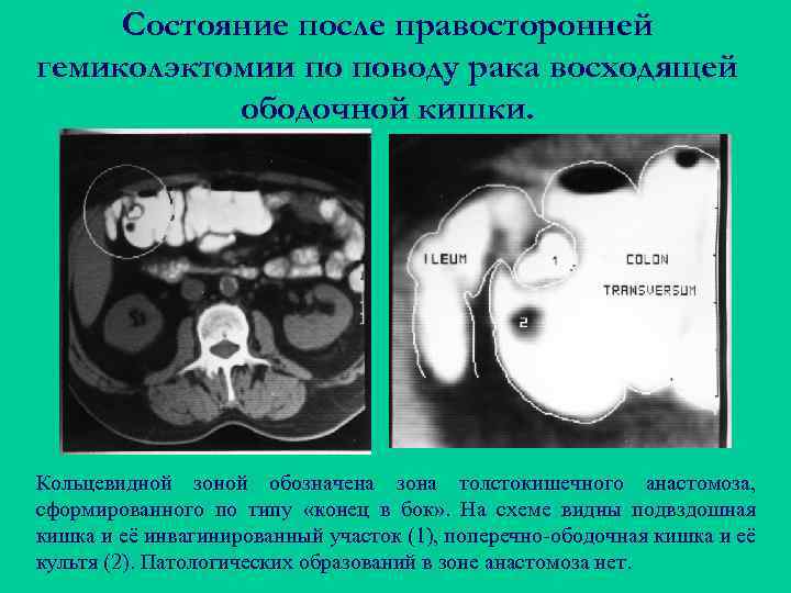 Состояние после правосторонней гемиколэктомии по поводу рака восходящей ободочной кишки. Кольцевидной зоной обозначена зона
