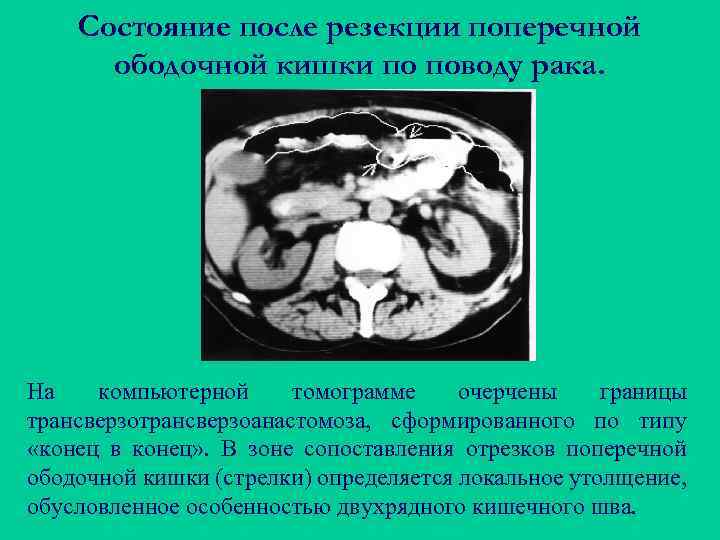 Состояние после резекции поперечной ободочной кишки по поводу рака. На компьютерной томограмме очерчены границы