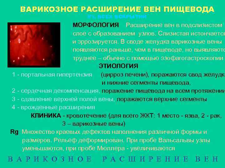 ВАРИКОЗНОЕ РАСШИРЕНИЕ ВЕН ПИЩЕВОДА 8% ВСЕХ ВСКРЫТИЙ МОРФОЛОГИЯ Расширение вен в подслизистом слое с
