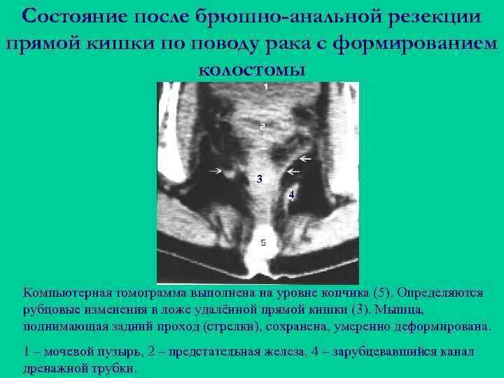 Состояние после брюшно-анальной резекции прямой кишки по поводу рака с формированием колостомы 3 4
