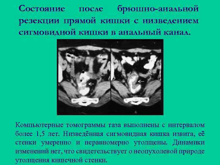 Состояние после брюшно-анальной резекции прямой кишки с низведением сигмовидной кишки в анальный канал. Компьютерные