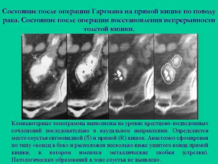 Состояние после операции Гартмана на прямой кишке по поводу рака. Состояние после операции восстановления