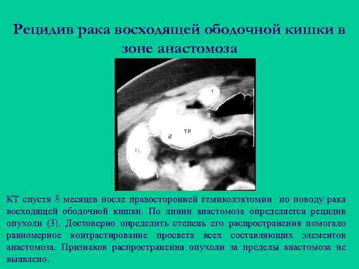 Рецидив рака восходящей ободочной кишки в зоне анастомоза КТ спустя 8 месяцев после правосторонней