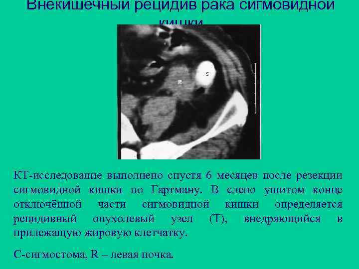 Внекишечный рецидив рака сигмовидной кишки КТ-исследование выполнено спустя 6 месяцев после резекции сигмовидной кишки