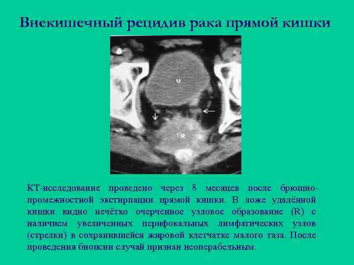 Внекишечный рецидив рака прямой кишки КТ-исследование проведено через 8 месяцев после брюшнопромежностной экстирпации прямой