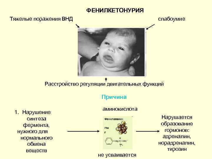 ФЕНИЛКЕТОНУРИЯ Тяжелые поражения ВНД слабоумие Расстройство регуляции двигательных функций Причина 1. Нарушение синтеза фермента,
