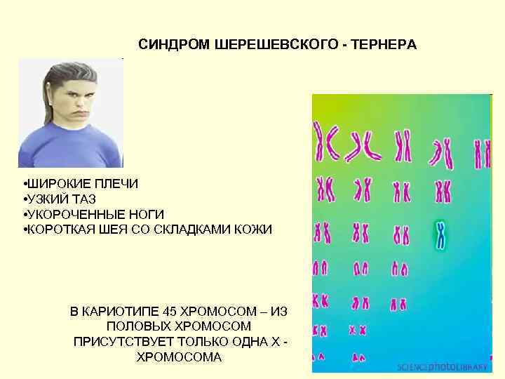 СИНДРОМ ШЕРЕШЕВСКОГО - ТЕРНЕРА • ШИРОКИЕ ПЛЕЧИ • УЗКИЙ ТАЗ • УКОРОЧЕННЫЕ НОГИ •