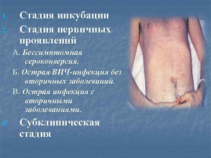 1. 2. Стадия инкубации Стадия первичных проявлений А. Бессимптомная сероконверсия. Б. Острая ВИЧ-инфекция без