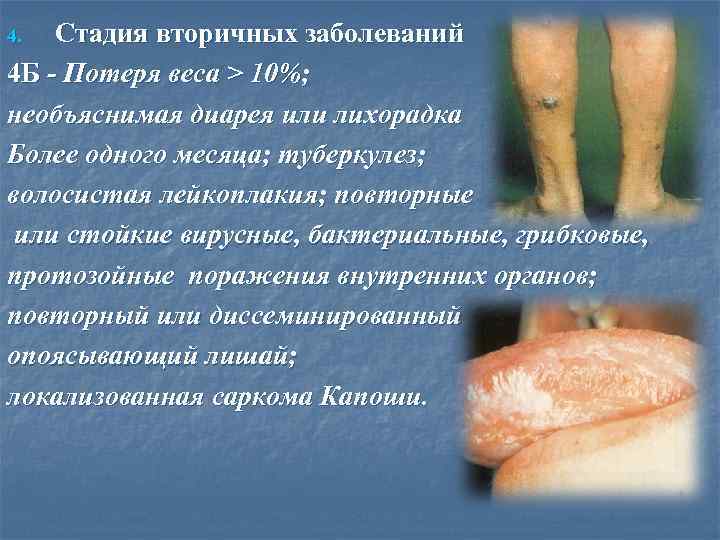 Стадия вторичных заболеваний 4 Б - Потеря веса > 10%; необъяснимая диарея или лихорадка