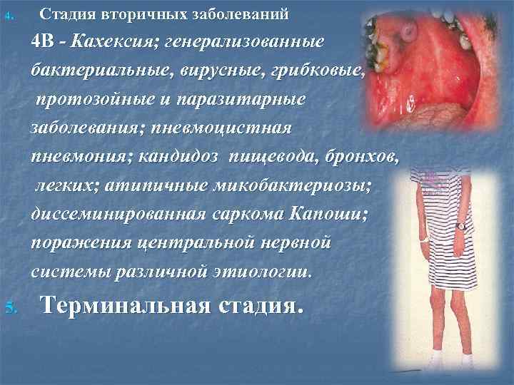 4. Стадия вторичных заболеваний 4 В - Кахексия; генерализованные бактериальные, вирусные, грибковые, протозойные и