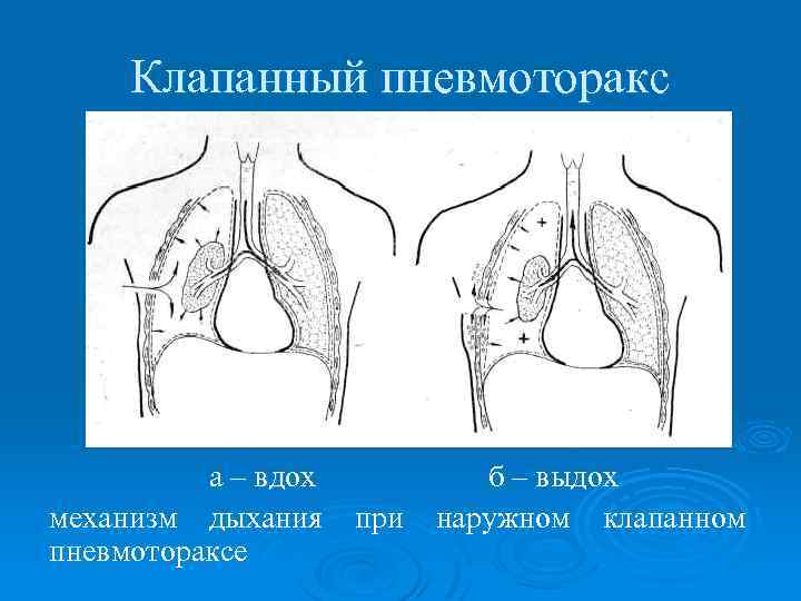 Клапанный пневмоторакс а – вдох б – выдох механизм дыхания при наружном клапанном пневмотораксе