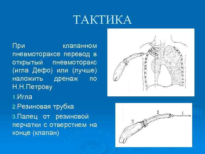 ТАКТИКА При клапанном пневмотораксе перевод в открытый пневмоторакс (игла Дефо) или (лучше) наложить дренаж