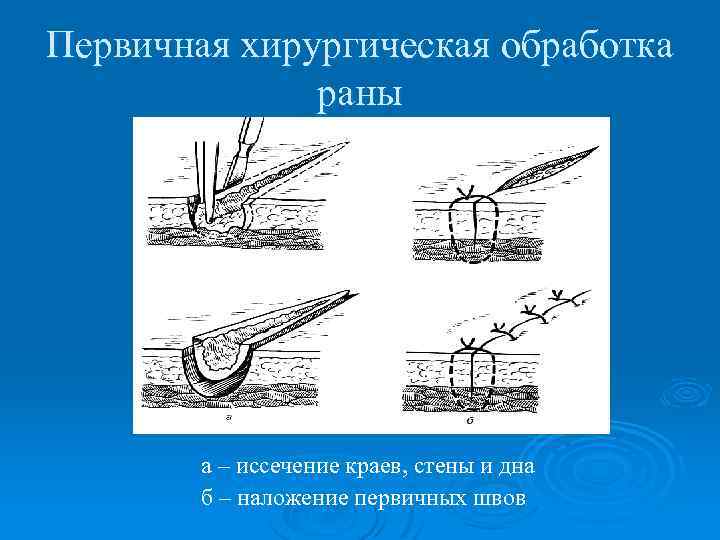 Первичная хирургическая обработка раны а – иссечение краев, стены и дна б – наложение