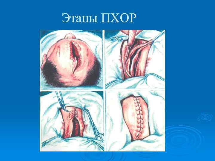 Этапы ПХОР 