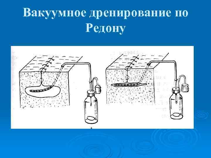 Вакуумное дренирование по Редону 