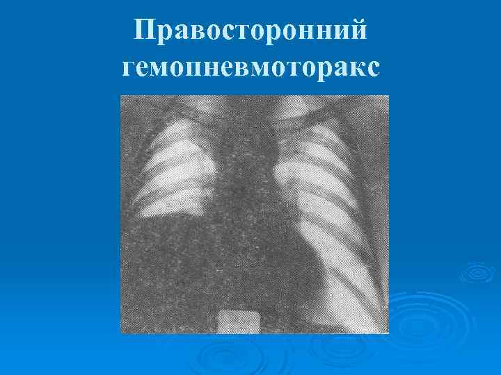 Правосторонний гемопневмоторакс 