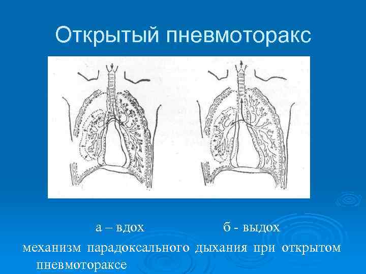 Открытый пневмоторакс а – вдох б - выдох механизм парадоксального дыхания при открытом пневмотораксе