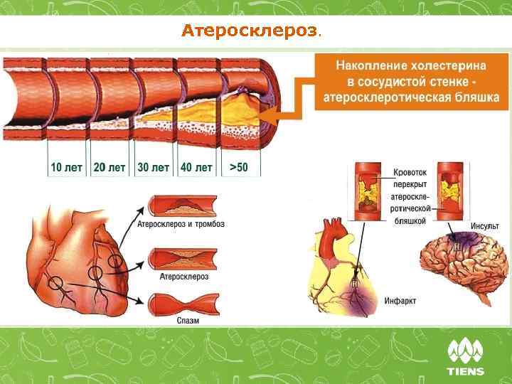 Атеросклероз. 