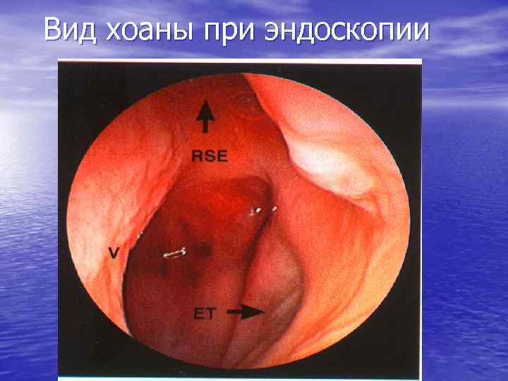 Вид хоаны при эндоскопии 