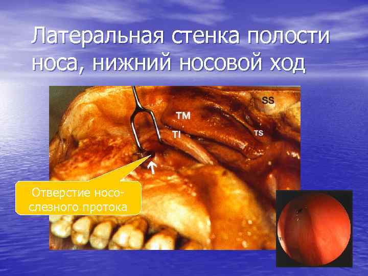 Латеральная стенка полости носа, нижний носовой ход Отверстие носослезного протока 