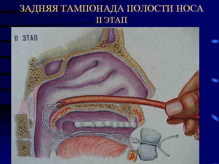 Альвеола ротовая полость. Задняя тампонада носовой полости. Задняя тампонада полости носа. Строение носа и пазух внутри.