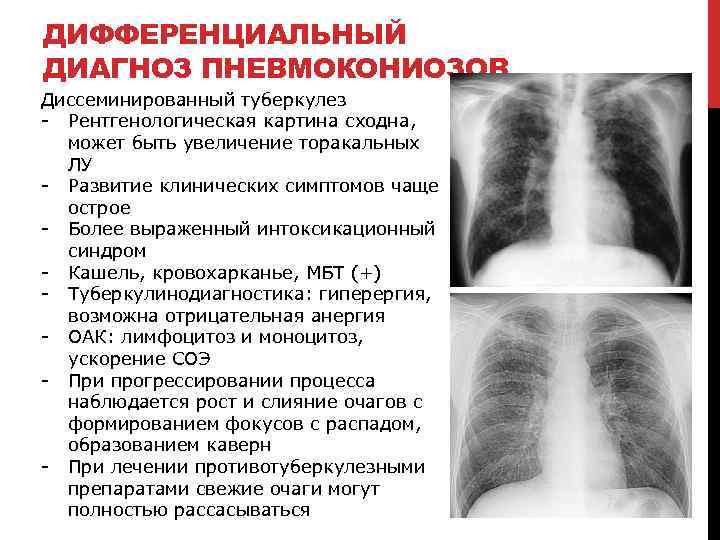 ДИФФЕРЕНЦИАЛЬНЫЙ ДИАГНОЗ ПНЕВМОКОНИОЗОВ Диссеминированный туберкулез - Рентгенологическая картина сходна, может быть увеличение торакальных ЛУ