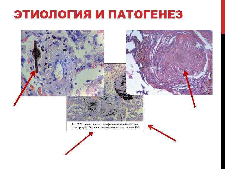 ЭТИОЛОГИЯ И ПАТОГЕНЕЗ 