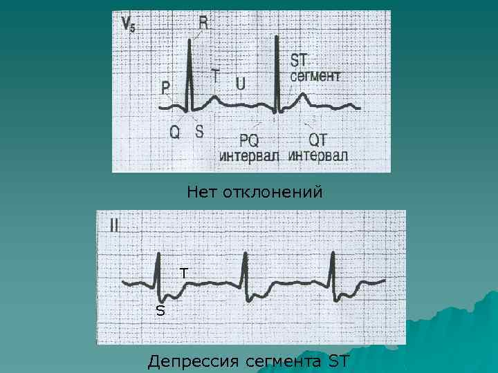 Нет отклонений T S Депрессия сегмента ST 