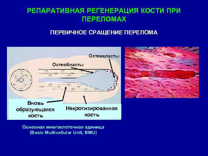 РЕПАРАТИВНАЯ РЕГЕНЕРАЦИЯ КОСТИ ПРИ ПЕРЕЛОМАХ ПЕРВИЧНОЕ СРАЩЕНИЕ ПЕРЕЛОМА Остеокласты Остеобласты Вновь образующаяся кость Некротизированная