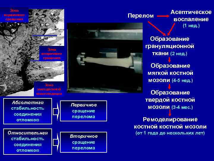 Зона первичного сращения Перелом Асептическое воспаление (1 нед. ) Образование грануляционной ткани (2 нед.