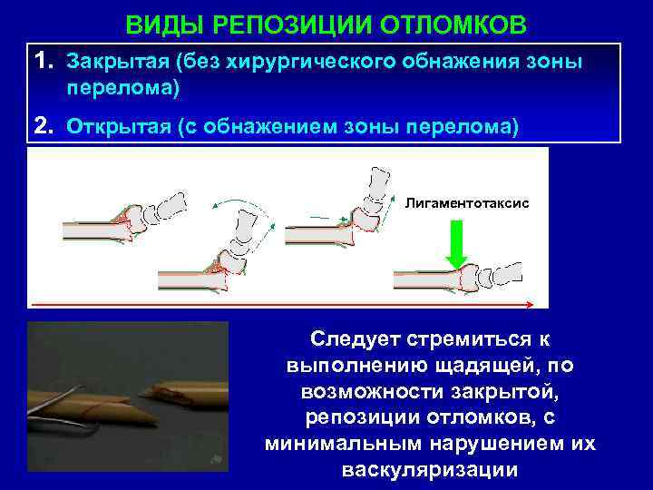 Открытая репозиция костных отломков