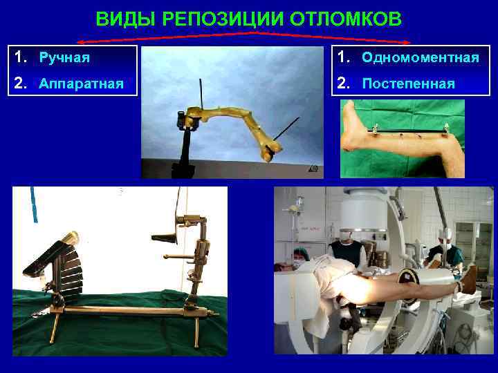 ВИДЫ РЕПОЗИЦИИ ОТЛОМКОВ 1. Ручная 1. Одномоментная 2. Аппаратная 2. Постепенная 