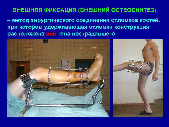 ВНЕШНЯЯ ФИКСАЦИЯ (ВНЕШНИЙ ОСТЕОСИНТЕЗ) – метод хирургического соединения отломков костей, при котором удерживающая отломки