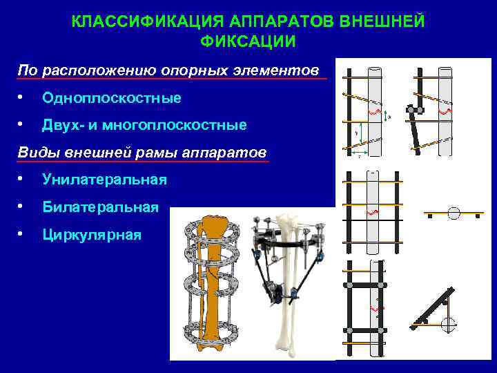 Виды аппаратов. Аппараты внешней фиксации классификация. Аппараты внешней фиксации одноплоскостные. Монолатеральный аппарат внешней фиксации. Остеосинтез стержневым аппаратом внешней фиксации.