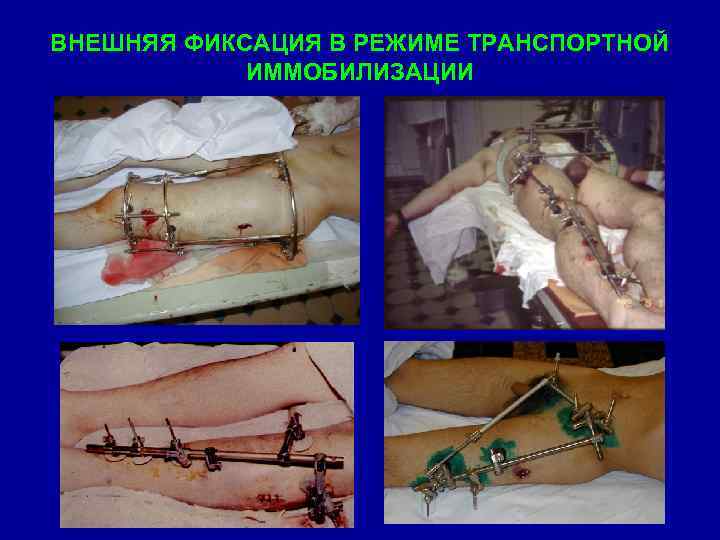 ВНЕШНЯЯ ФИКСАЦИЯ В РЕЖИМЕ ТРАНСПОРТНОЙ ИММОБИЛИЗАЦИИ 