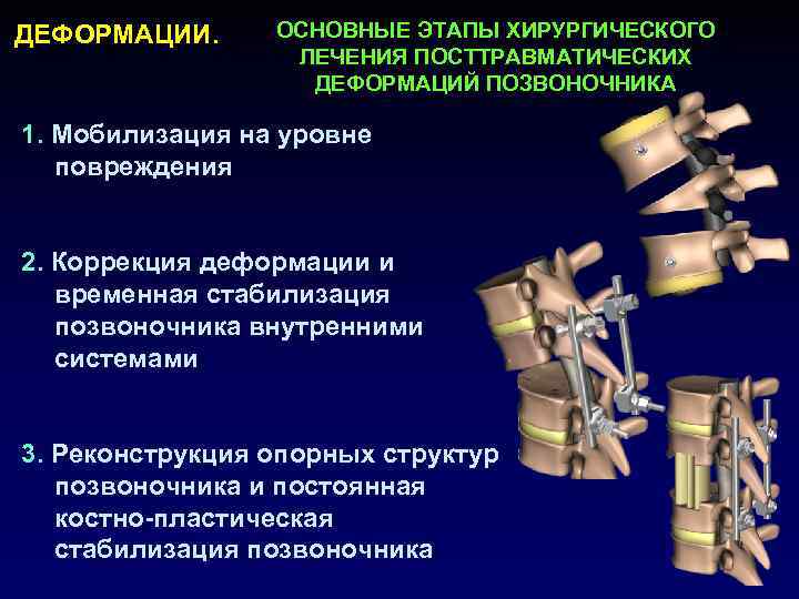 ДЕФОРМАЦИИ. ОСНОВНЫЕ ЭТАПЫ ХИРУРГИЧЕСКОГО ЛЕЧЕНИЯ ПОСТТРАВМАТИЧЕСКИХ ДЕФОРМАЦИЙ ПОЗВОНОЧНИКА 1. Мобилизация на уровне повреждения 2.