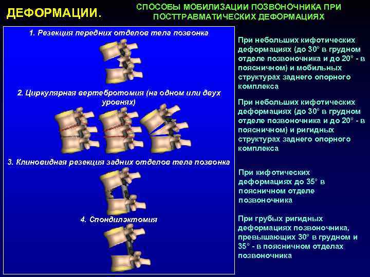 ДЕФОРМАЦИИ. СПОСОБЫ МОБИЛИЗАЦИИ ПОЗВОНОЧНИКА ПРИ ПОСТТРАВМАТИЧЕСКИХ ДЕФОРМАЦИЯХ 1. Резекция передних отделов тела позвонка 2.