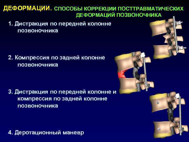 Переломы позвоночника презентация травматология