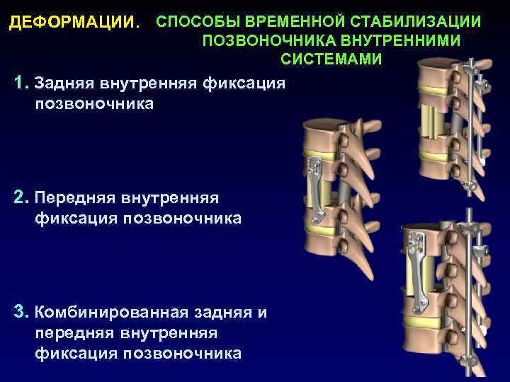 ДЕФОРМАЦИИ. СПОСОБЫ ВРЕМЕННОЙ СТАБИЛИЗАЦИИ ПОЗВОНОЧНИКА ВНУТРЕННИМИ СИСТЕМАМИ 1. Задняя внутренняя фиксация позвоночника 2. Передняя